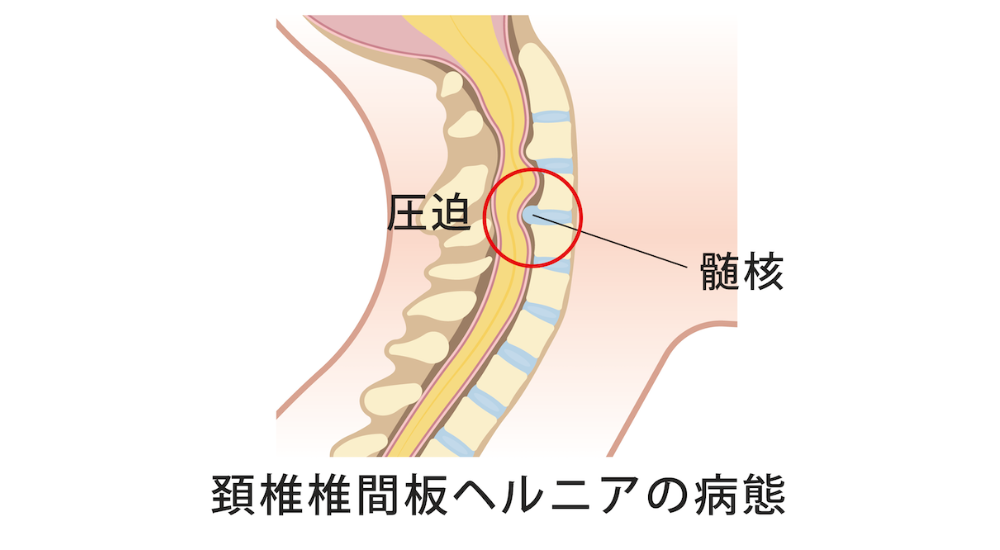 北浦和で肩こり改善におすすめの整体-北浦和肩こり専門整体院の肩こり‐首こり、首の痛みの整体について‐画像10